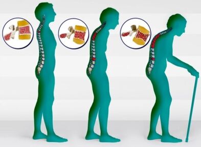 Osteoporosis
